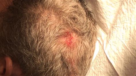 Scalp Cyst Removal 20180226 - YouTube