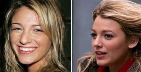 Rumors Blake Lively Nose Job Plastic Surgery Before and After