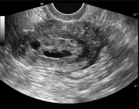 Endometrial hyperplasia ultrasound - wikidoc