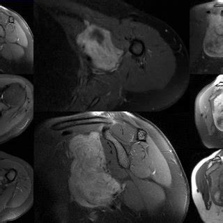 a) Swelling appearance of biopsied axillary mass, b) during operation,... | Download Scientific ...