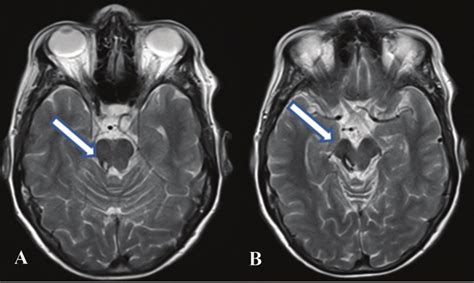 Axial T2-weighted Magnetic Resonance Imaging Scans of Patient 1 (A,B ...