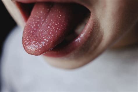 Strawberry Tongue: Symptoms, Causes, and Treatment