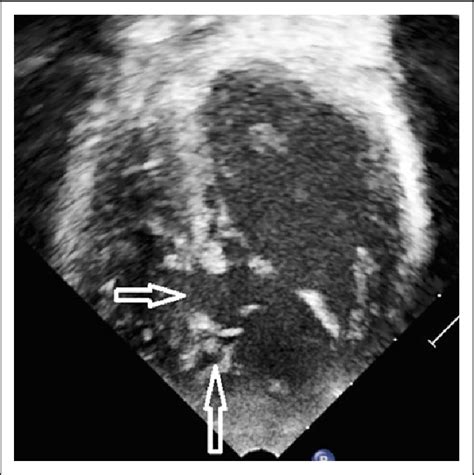 Echocardiography, modified apical four-chamber view: Anteriorly... | Download Scientific Diagram