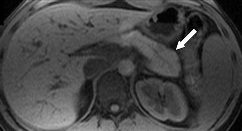 Chronic Pancreatitis Ercp