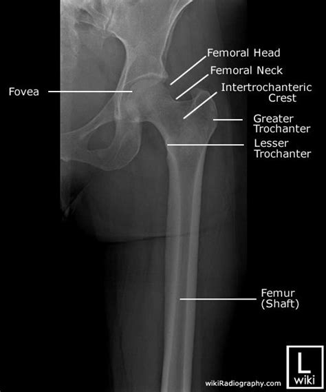 Femur Radiographic Anatomy | Radiology student, Medical anatomy ...