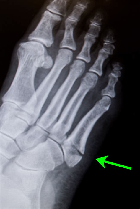 Foot Injury with Fracture - Friendly Foot Care PC