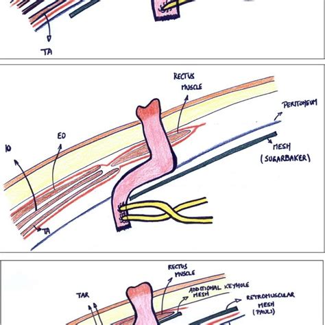 Flow chart of different surgical techniques in ileal conduit parastomal ...