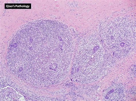 Flickriver: Photoset 'Acute Mastitis' by Qiao's Pathology (Art and Science in Medicine)