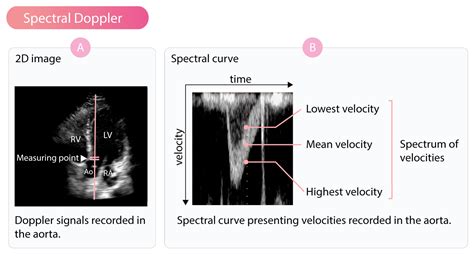 Doppler effect and Doppler echocardiography – Cardiovascular Education