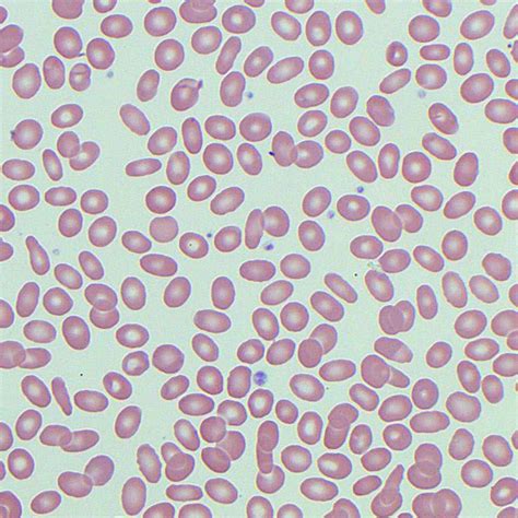 Poikilocytosis | Blood Film - MedSchool