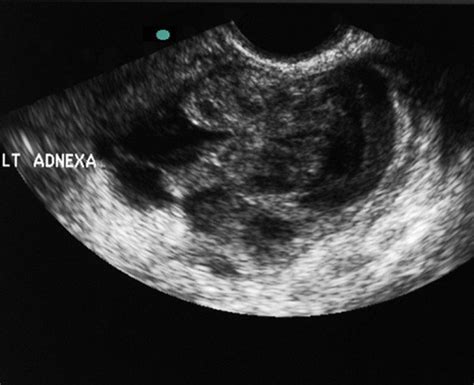 Tubo Ovarian Abscess On Ultrasound