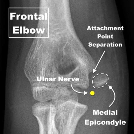 Medial Epicondyle Fractures in Young Athletes