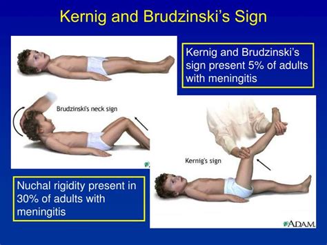 PPT - Meningitis PowerPoint Presentation - ID:4591726