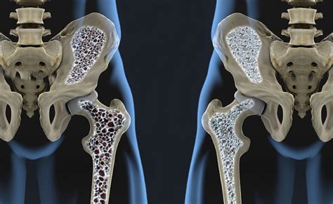 Management of Glucocorticoid-Induced Osteoporosis: An Overview - Endocrinology Advisor