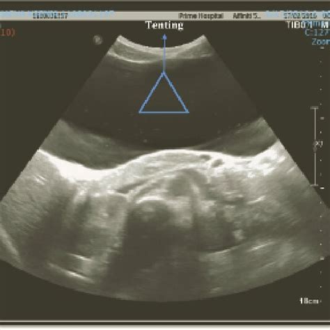 Abdominal ultrasound scan showing the cyst occupying the epigastric... | Download Scientific Diagram