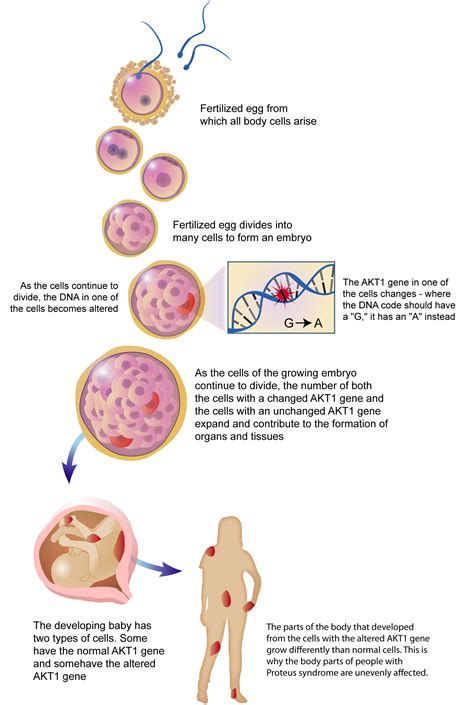 Proteus syndrome - Wikipedia