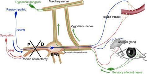 Vidian Neurectomy for Management of Chronic Cluster Headache - Neurosurgery Blog