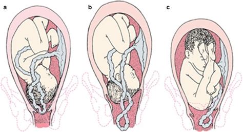 Umbilical Cord Prolapse Causes Of Umbilical Cord Prolapse | Hot Sex Picture