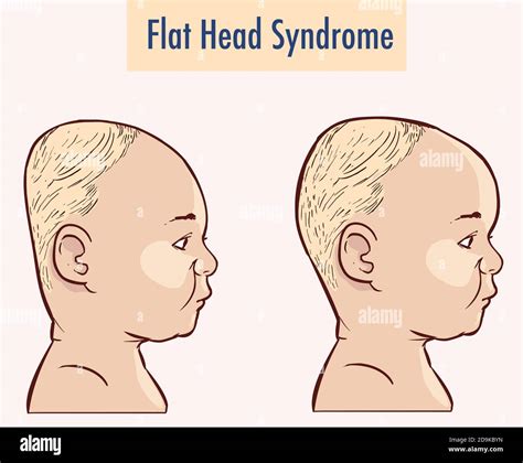 Flat Head Syndrome Brain vector illustration Stock Vector Image & Art ...