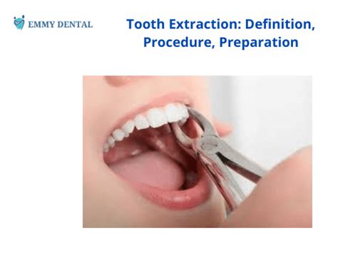 Top 4 Things You Must Know About Tooth Extraction