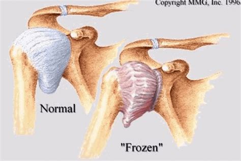 Frozen Shoulder