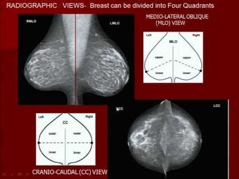 Pin on 유방초음파,Mammography