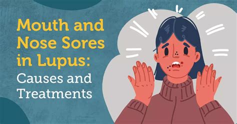 Mouth and Nose Sores in Lupus: Causes and Treatments | MyLupusTeam