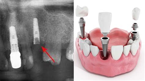 Dental Implant Removal - Anesthesia Options, Recovery Time, and Possible Complications - PRV Dental