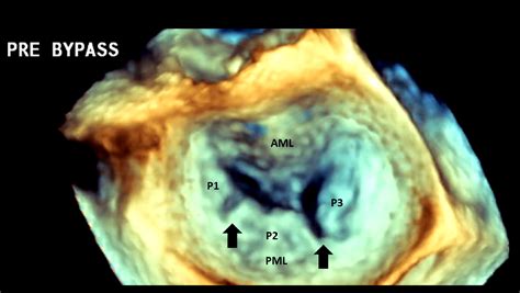 Mitral Valve Cleft-like Indentations in Hypertrophic Obstructive ...