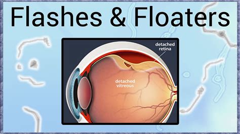 Eye Floaters And Flashes Of Light Linked To Retinal Tear Detachment ...