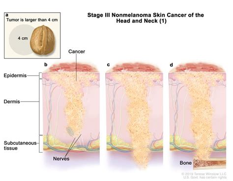 Squamous cell carcinoma (SCC), a skin cancer | Medika Life : Skin Cancer