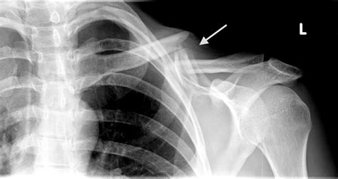 Cureus | Improved Functional Outcomes Following Operative Treatment of Midshaft Clavicle ...