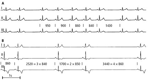 Figure 031_3152. Electrocardiography (ECG) of a patient with sinus node dysfunction: A , second ...