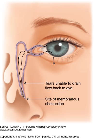 Disorders of the Lacrimal System | Ento Key