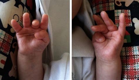 Cortical Thumb Sign - The Journal of Pediatrics