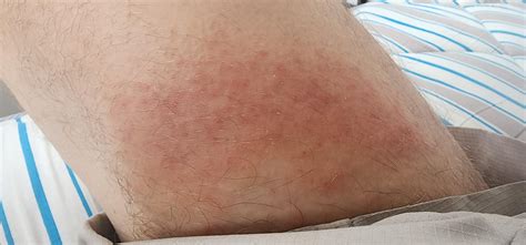 Itchy leg and inner thigh rash. : r/DermatologyQuestions