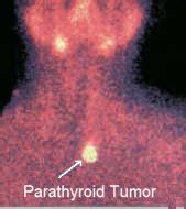 Parathyroid Sestamibi Scan Technical Page: How Parathyroid Sestamibi Scanning is Performed. This ...