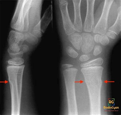 Torus Fracture | Radiology Case | - RadioGyan