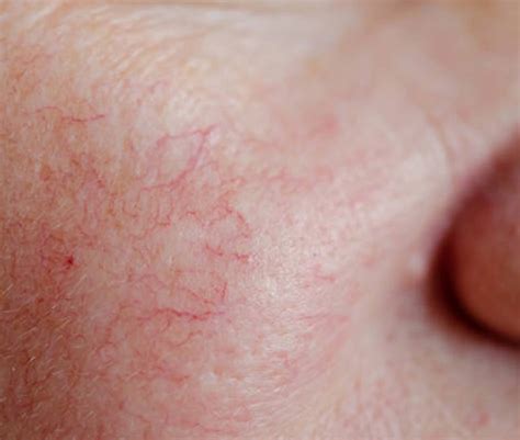 Close up of human face skin with vascular problems, couperose on sensitive skin