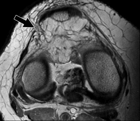 A Focal Defect at the Lateral Patellar Retinaculum on Clinical Knee MRI and Cadaveric Study: A ...