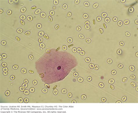 Rbc Cell In Urine