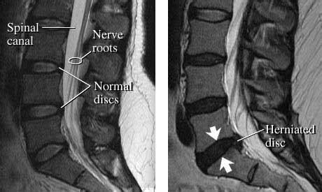 I have back pain - should I have an X-ray? - Osteopathy Abingdon