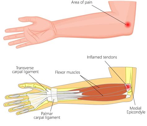 Dr. Recommendations For Elbow Pain When Lifting Weights Or Other Things