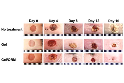 Oxygen-delivering hydrogel accelerates diabetic wound healing - The ...