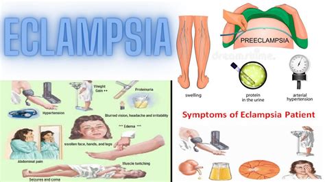 Eclampsia - Definition, Clinical Features, Complications, Management ...