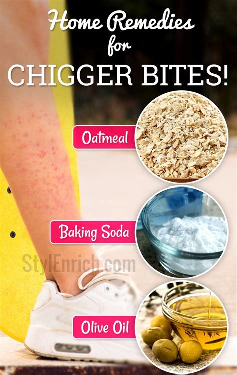 Home Remedies for Chigger Bites Which Can Provide Instant Relief