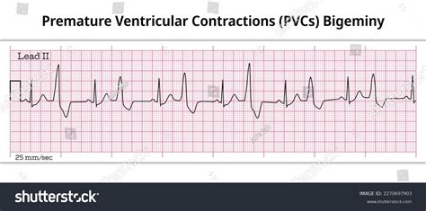 Bigeminy Premature Ventricular Contractions Pvcs Ventricular Stock Vector (Royalty Free ...