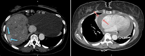 Hemopericardium: A Comprehensive Clinical Review of Etiology and ...