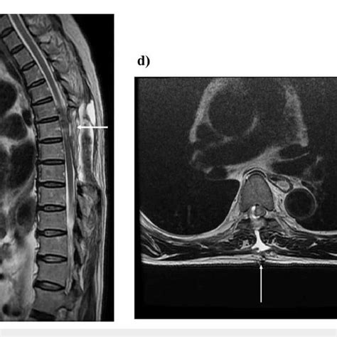 Thoracic spine intradural extramedullary tumor (Th6). Postoperative... | Download Scientific Diagram