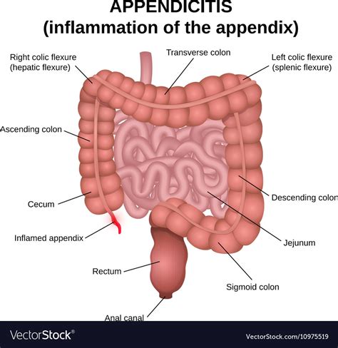 Appendix & Appendicectomy | Dr Ahuja Clinic Chandigarh | Dr. Ruchi Rai Ahuja | Dr Alok Ahuja